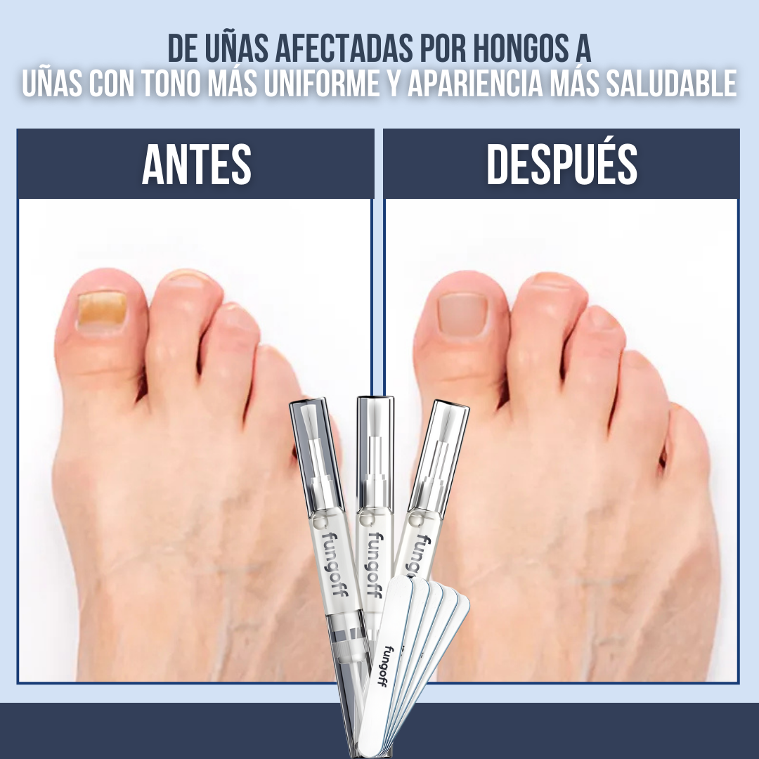 Fung Off™ – Precisión directa para uñas más sanas